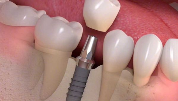 Kada i zašto ugraditi zubni implantat